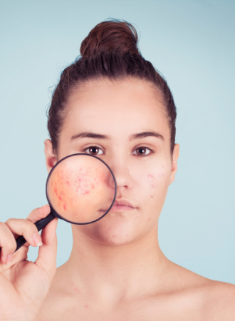 Limpeza e Clareamento de Acne