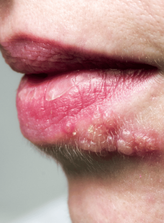 Cápsulas Preventiva de Herpes Labial