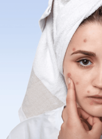 Cápsulas para Acne Inflamatória