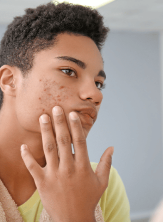 Bastão Secativo para Acne