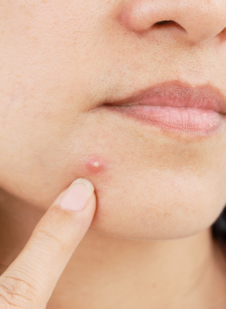 Loção Ultrassecativa para Acne