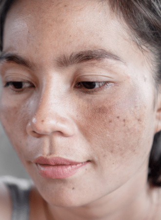 Peeling Home Care para Acne