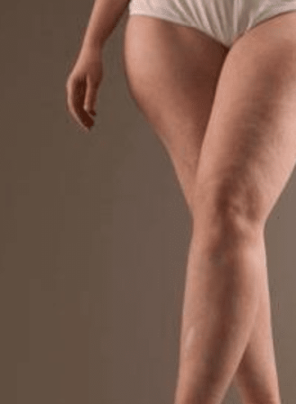 Cápsula Contra Lipedema