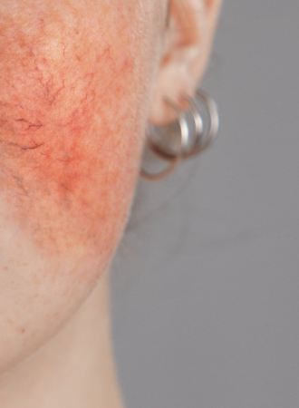 Creme para Melasma e Rosácea
