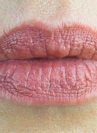 Gloss para Redução de Rugas Verticais
