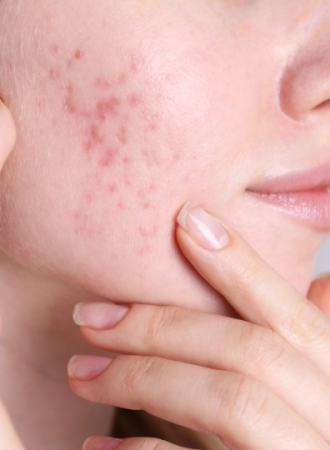 Creme para Cicatrizes de Acne