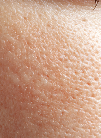 Sérum Redutor de Poros