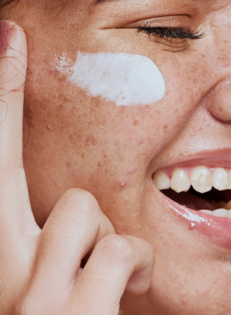 Creme para Melasma 2 Creme para Melasma 2