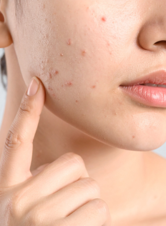 Creme para Prevenção de Acne Creme para Prevenção de Acne